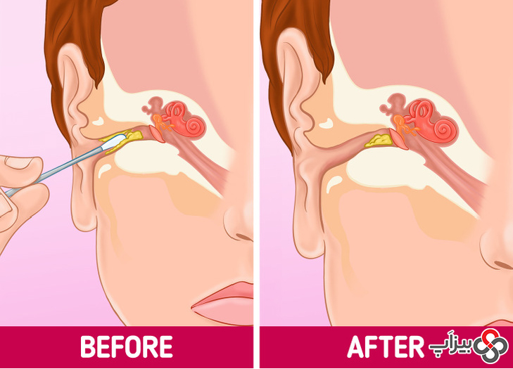گوش‌ پاک‌ کن‌ ها ممکن است جرم گوش را بیشتر به داخل گوش فشار دهند