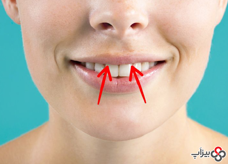 7. با فشار دادن روی لثه فوقانی، خونریزی بینی را متوقف کنید